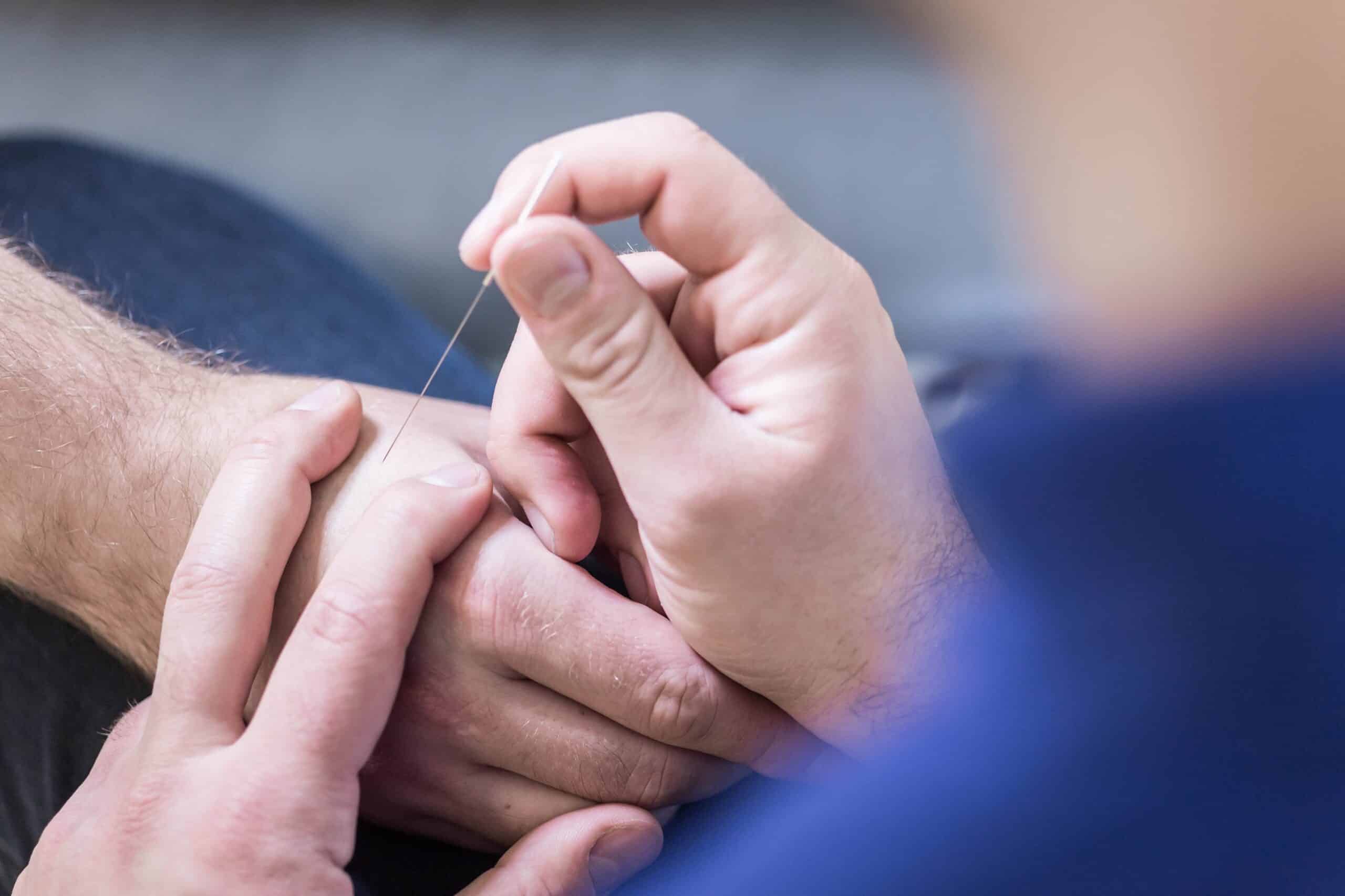 Using Acupuncture For Bipolar Depression